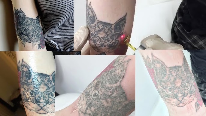 Vanish: Where Tattoos Disappear, Confidence Appears in Toronto