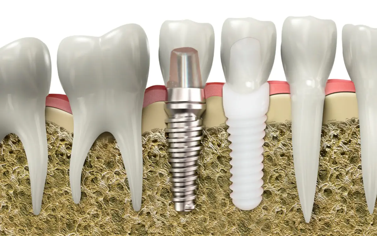 Bugetul Zâmbetului Perfect: Analiza Costului unui Implant Dentar